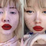trị mụn trứng cá hiệu quả | làm sao để hết mụn | cách nào để không nổi mụn