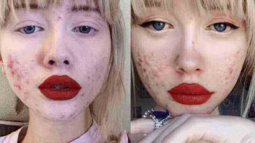 trị mụn trứng cá hiệu quả | làm sao để hết mụn | cách nào để không nổi mụn